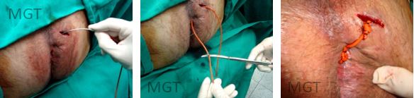 Cirurgia de fistula anal simples